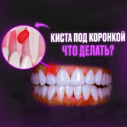 КИСТА ПОД КОРОНКОЙ ЗУБА? ПОСЛЕДСТВИЯ И ЧТО ДЕЛАТЬ?
